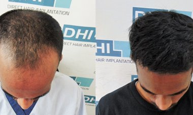 Exclusive Technique Now Available Only in DHI's Authorized Clinics